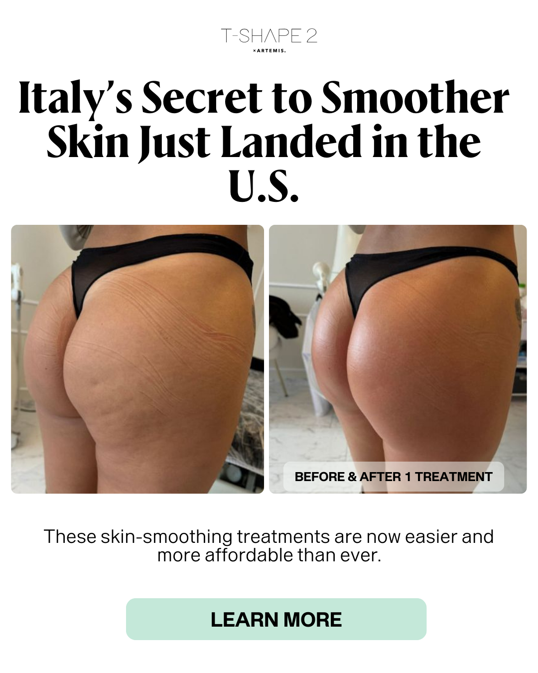 Buttock smoothing before and after