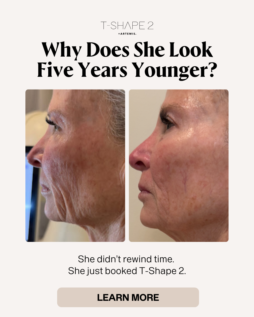 Face tightening before and after